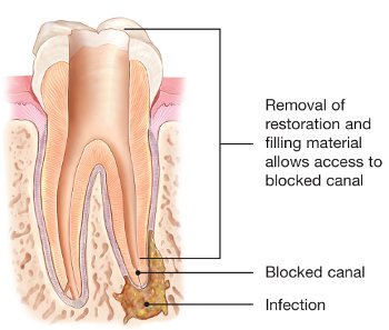 Endodontics retreatment Endodontics retreatment