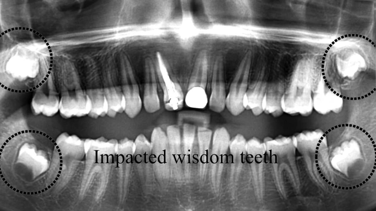 After Extraction of Wisdom Teeth After Extraction of Wisdom Teeth