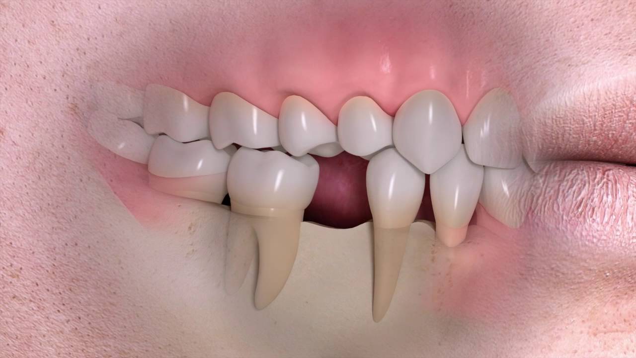 Jaw bone loss and deterioration natick family dental ma 
