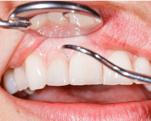Gum Graft surgery Gum Graft surgery