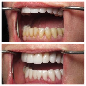 Porcelain Veneers Post Op Porcelain Veneers Post Op